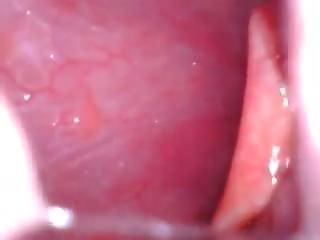 Half-Pipe reccomend endoscope mouth